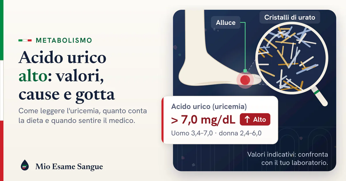 Acido urico alto: iperuricemia, cristalli di urato e gotta Piede di profilo con l'alluce arrossato, lente sui cristalli di urato e scheda dell'acido urico oltre 7,0 mg/dL