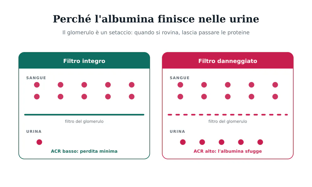 Confronto fra un glomerulo integro che trattiene l'albumina e un glomerulo danneggiato che la lascia passare nelle urine